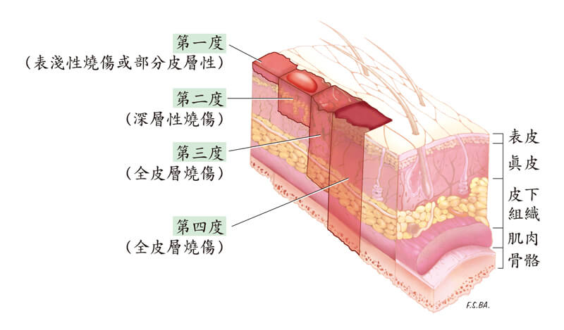 烧烫伤分级